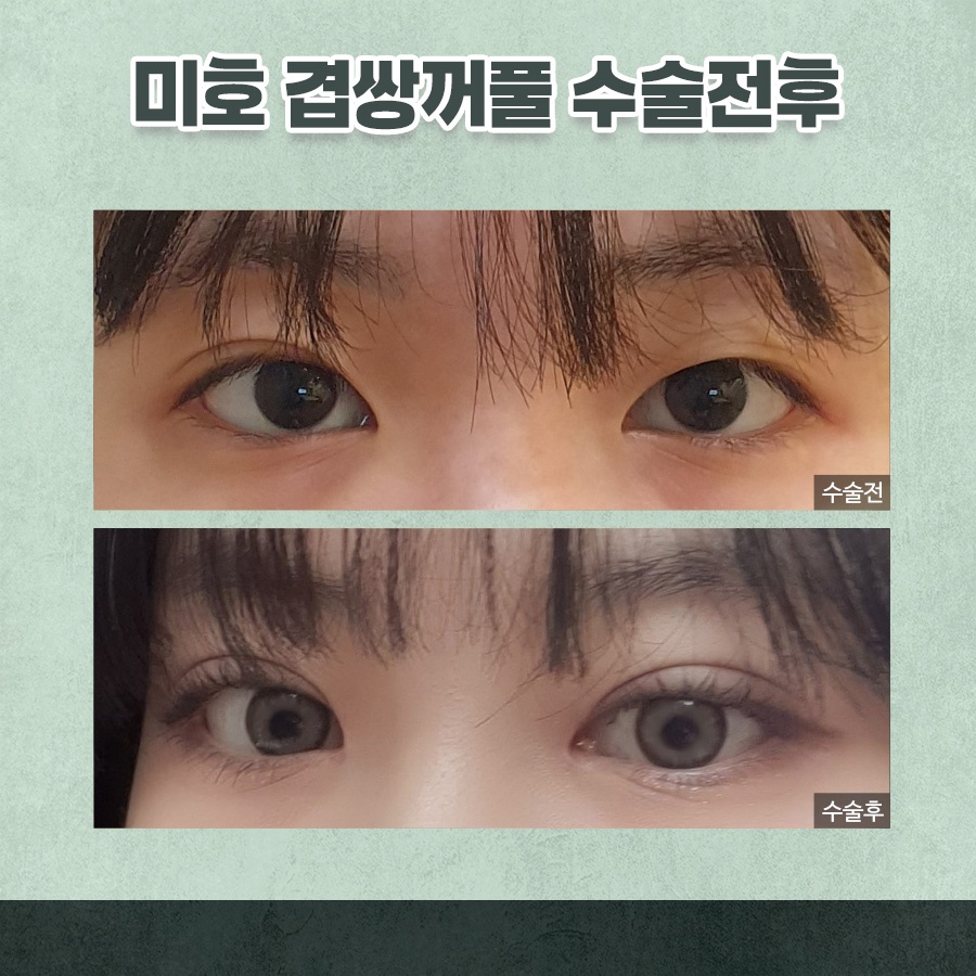 겹주름교정 자연스럽게 완성하려면 관련 이미지 7