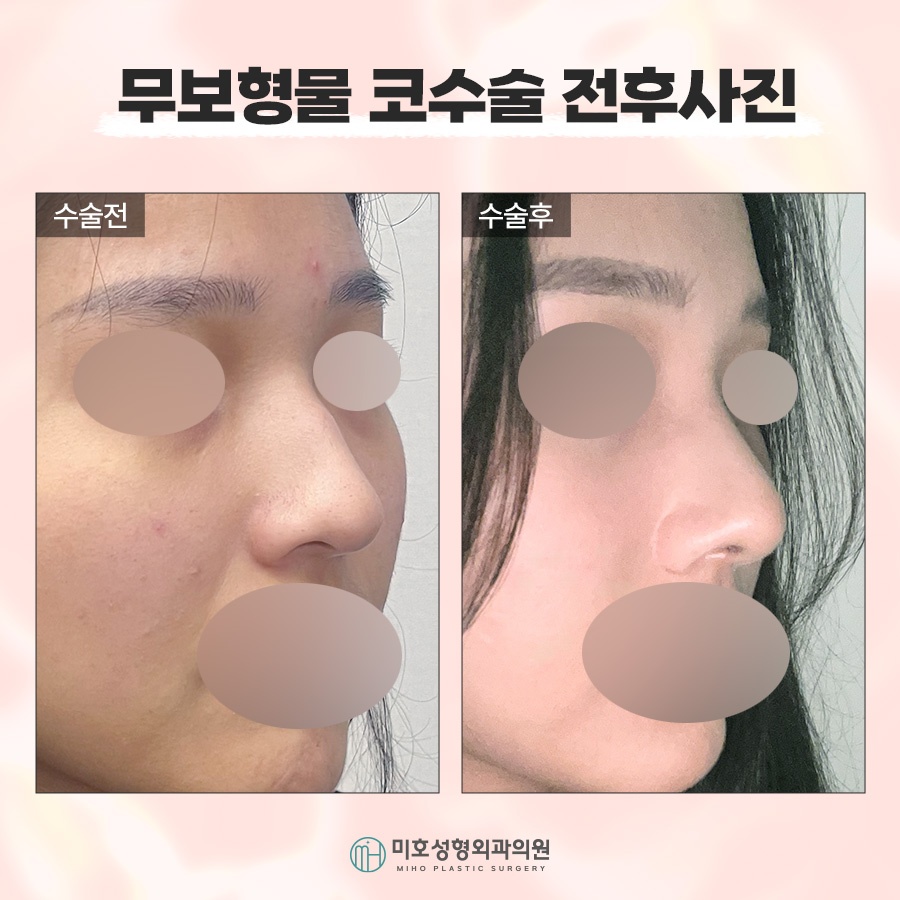 If You Want Harmonious Lines with Nose Surgery Without Implants image 8