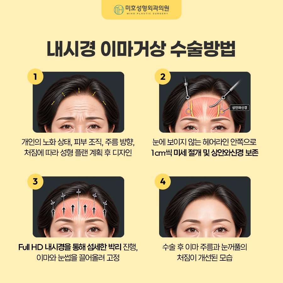 내시경이마거상 부기와 회복기간, 유지기간까지 알아보기 관련 이미지 3