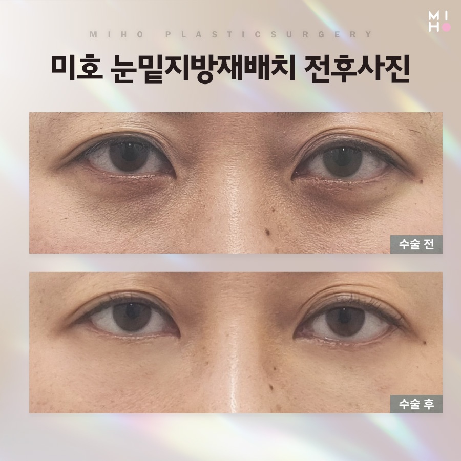눈밑꺼짐 원인에 맞게 관련 이미지 10