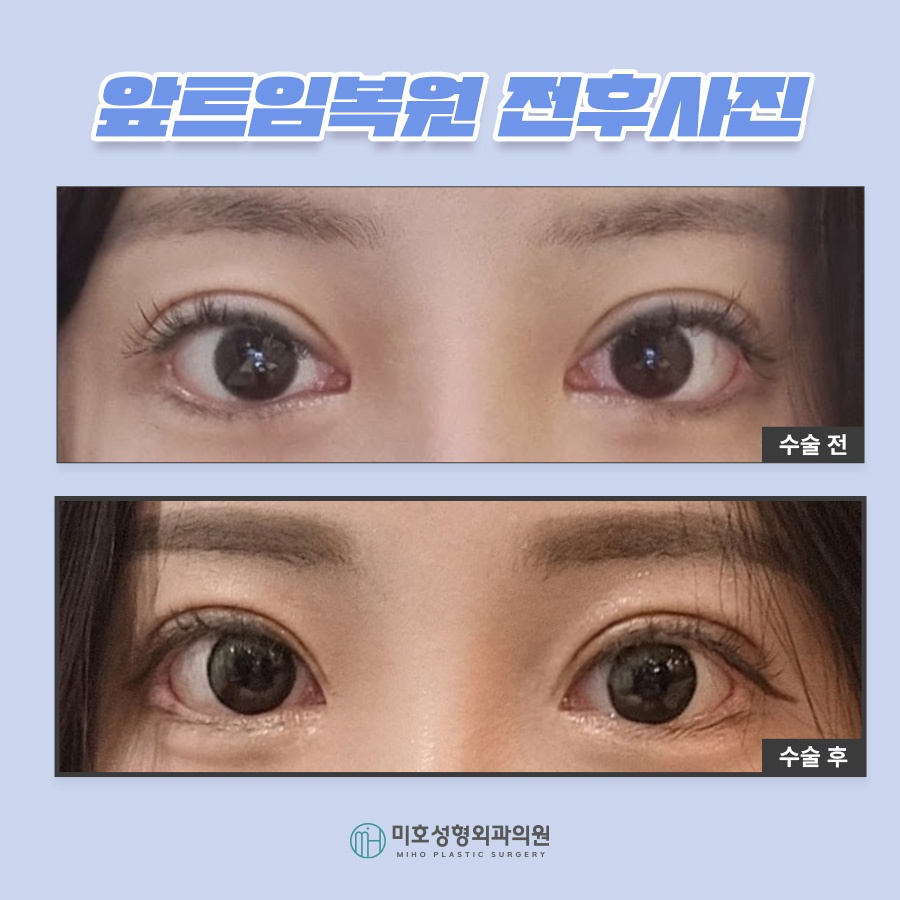 앞트임복원 제대로 알기 관련 이미지 8
