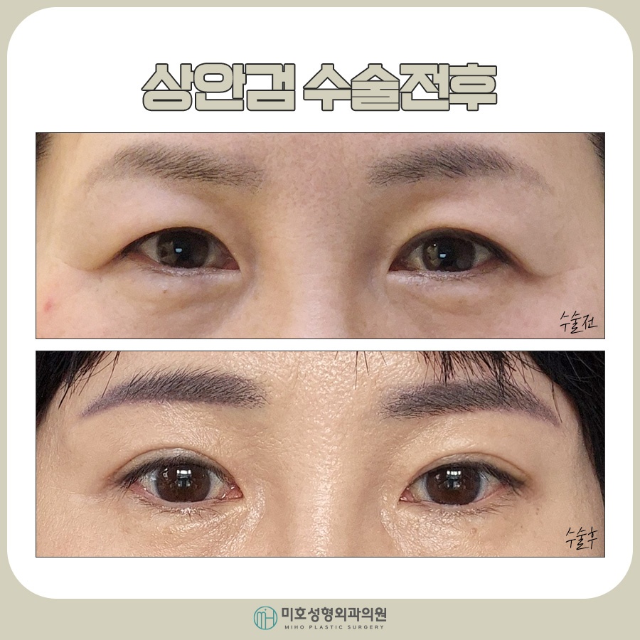 Factors to Consider for Upper Eyelid Surgery Costs image 7