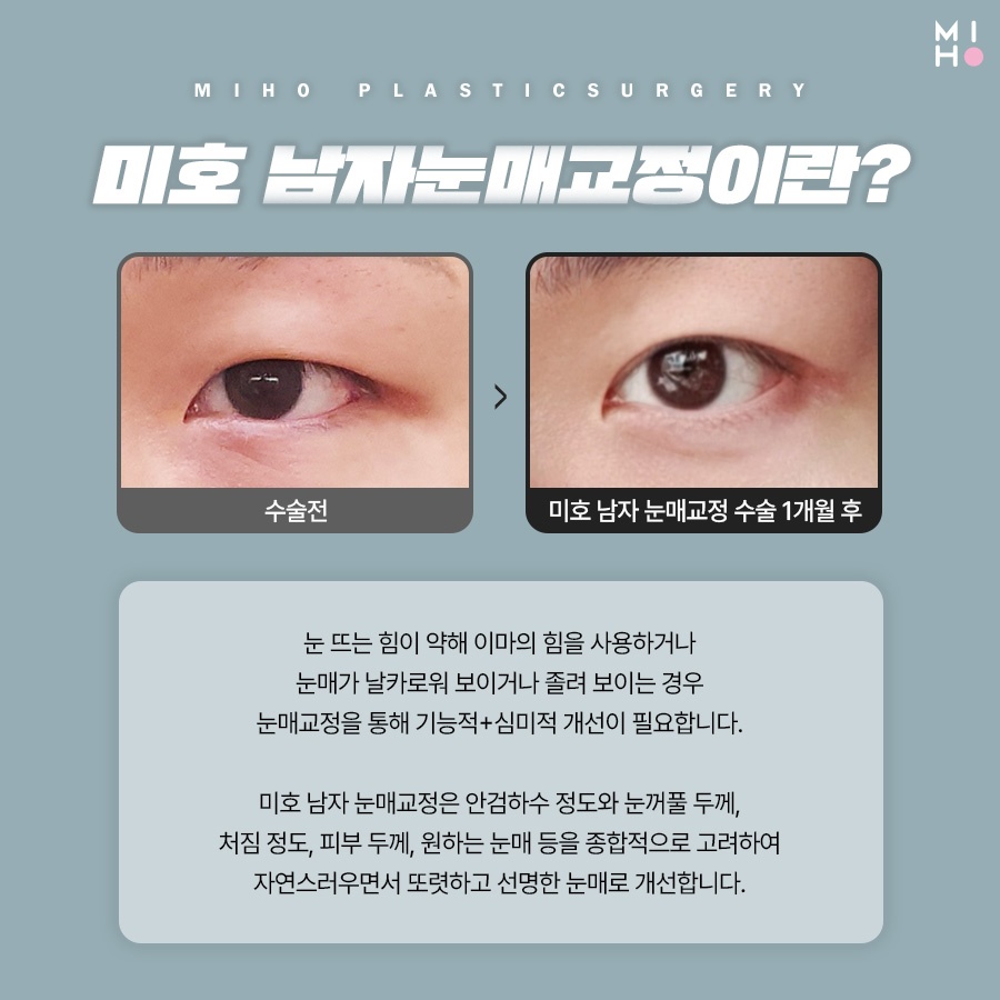 남자눈매교정 무쌍부터 유쌍까지 시원하게 관련 이미지 2