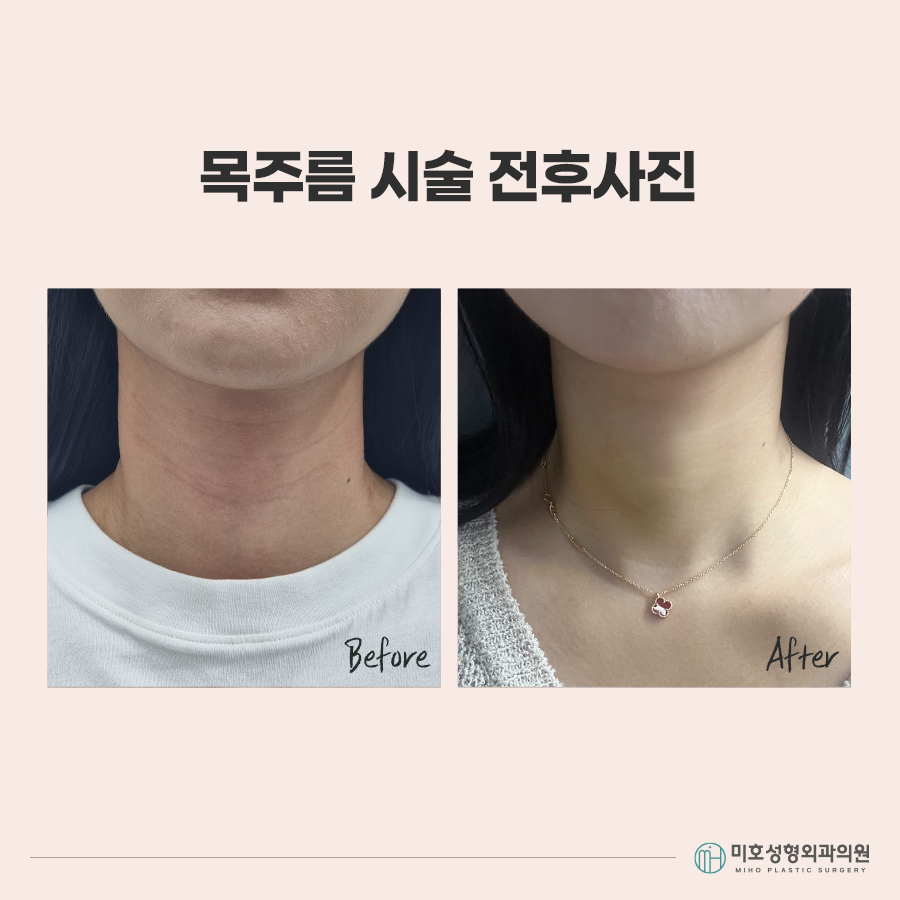 목주름시술 선명한 가로선이 고민이라면 관련 이미지 7