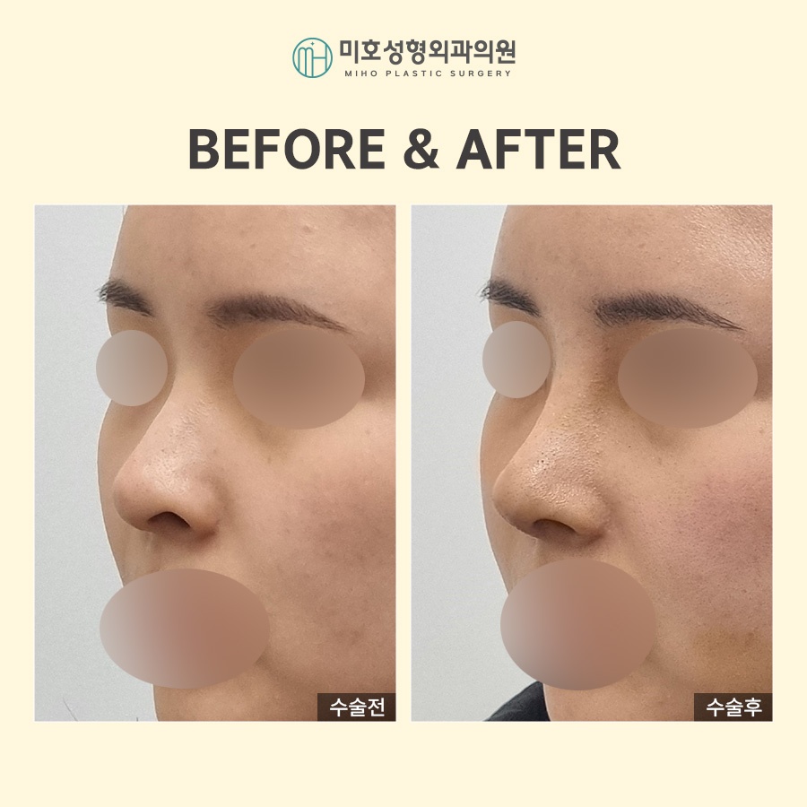 Adjusting the Approach According to the Type of Nostril-Lowering Procedure image 5