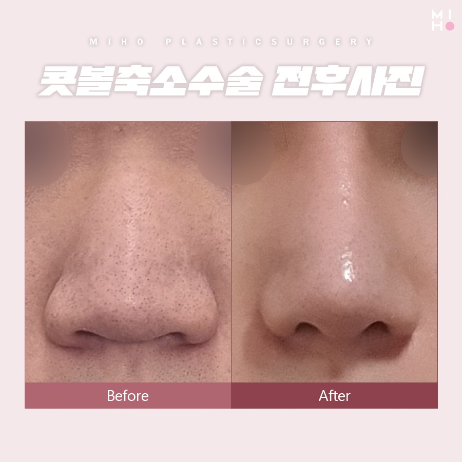 콧볼축소수술 나에게 적합한 방식으로 관련 이미지 8