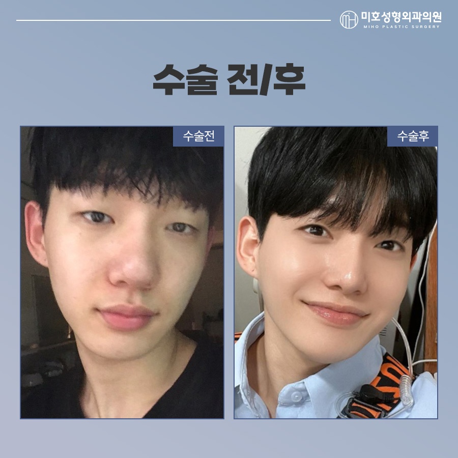 남자코 성별에 따른 차이점을 인지하여 관련 이미지 10