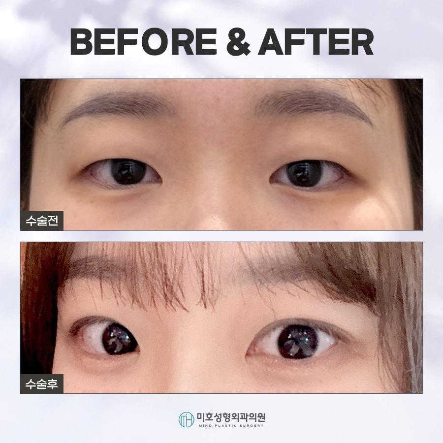 속쌍눈매교정에 관심을 두고 있다면 관련 이미지 8