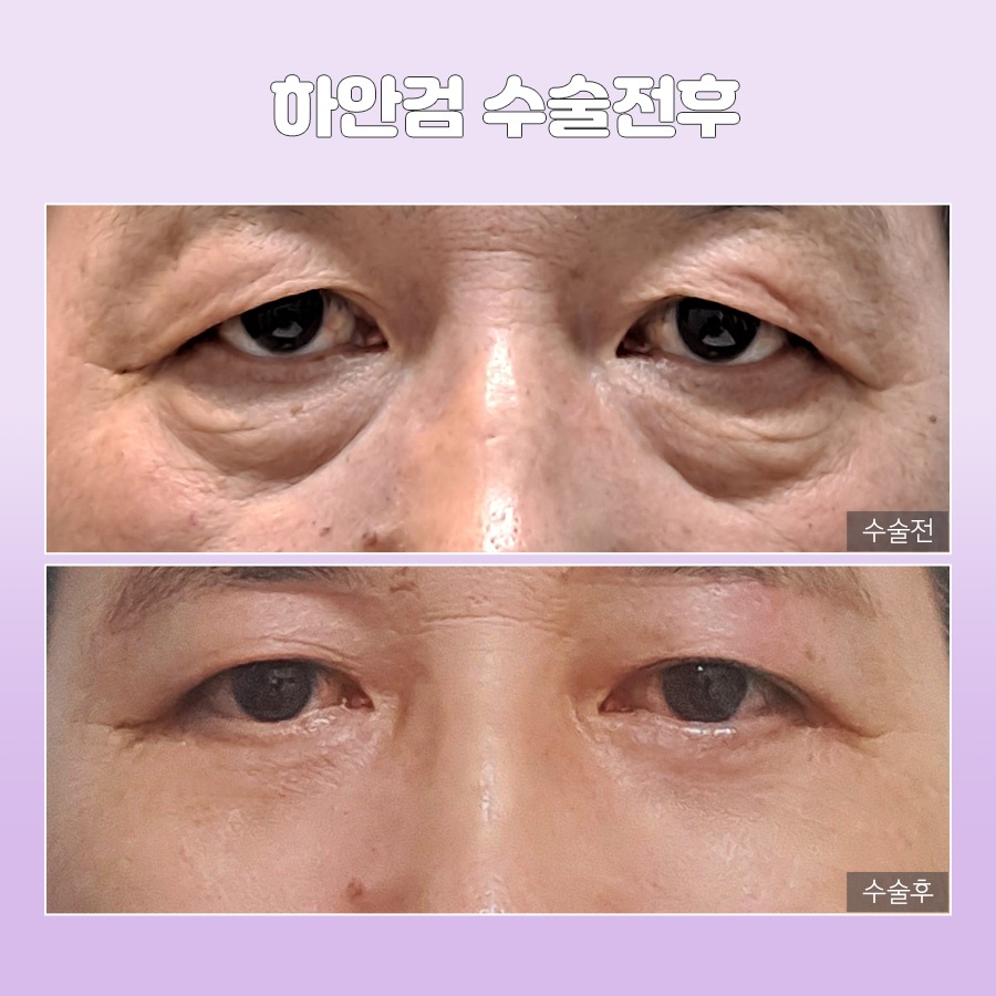 미호 시그니처 눈밑성형 지방재배치 눈매 개선 관련 이미지 9