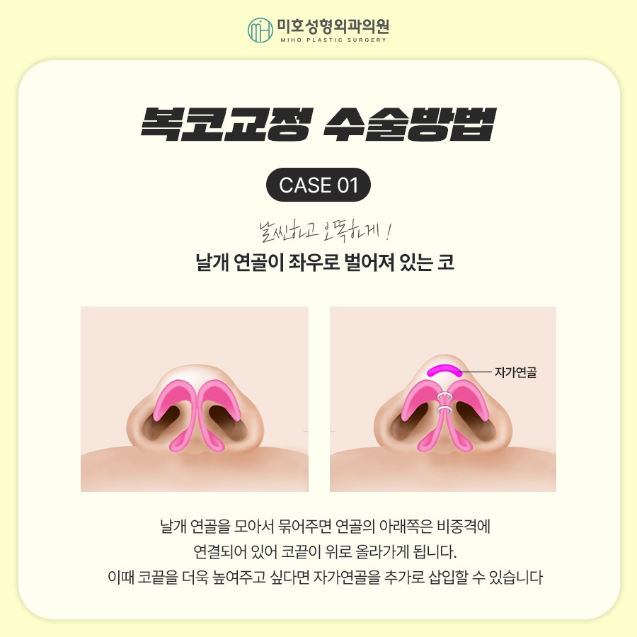 Naturally Improve the Bulbous Nose Complex image 4