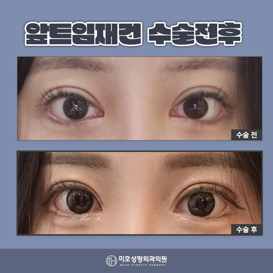 앞트임재건 미세함의 차이로 관련 이미지 10
