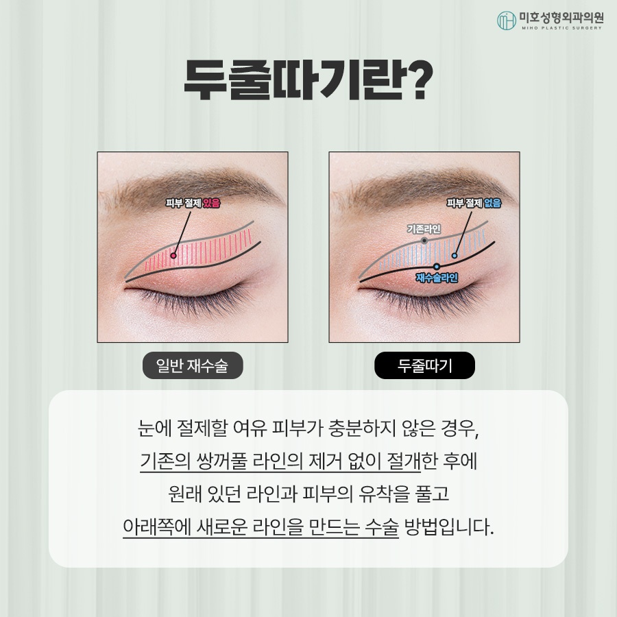 Differences Between One-Line and Two-Line Correction and Causes of Sausage Eyes image 2