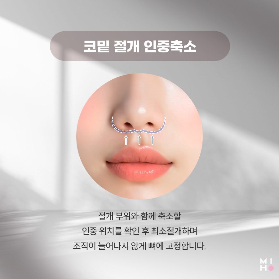 인중축소 중안부 짧은 동안 얼굴로 관련 이미지 18