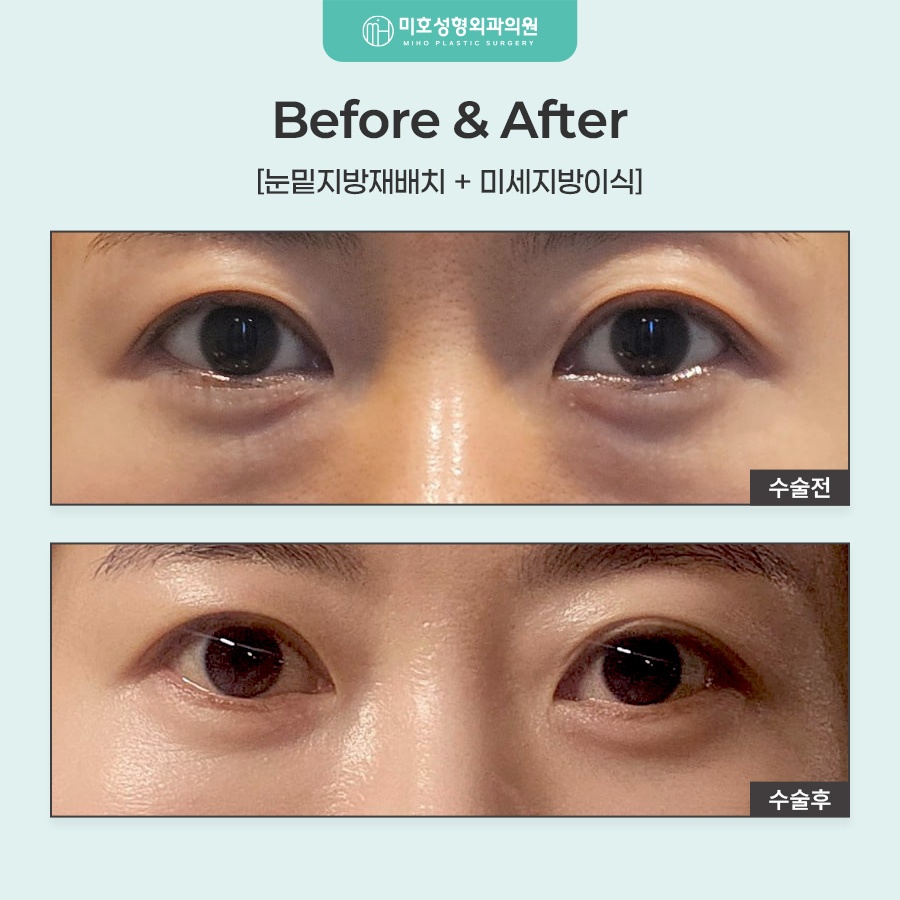 눈밑지방재배치 어두운 인상이 고민이라면 관련 이미지 7