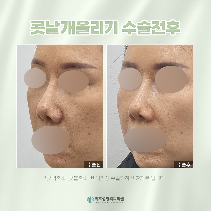 콧날개올리기 처진 코 교정 관련 이미지 7