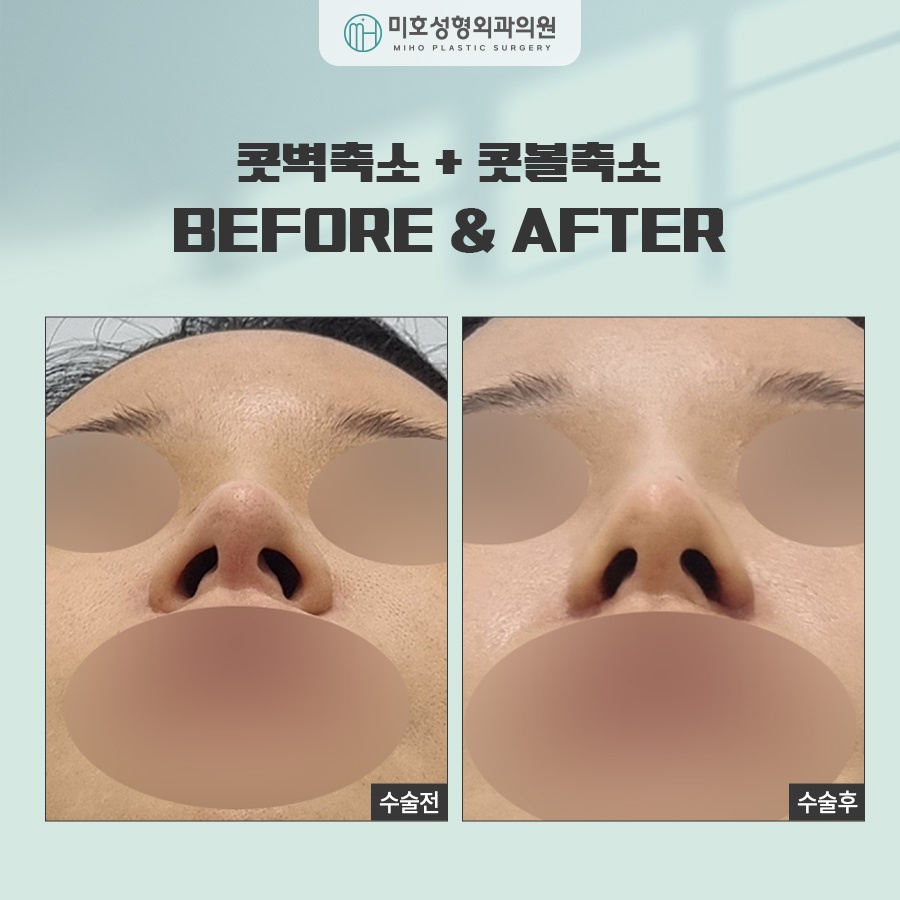 Comprehensive Guide to Alar Reduction Procedure and Aftercare image 6