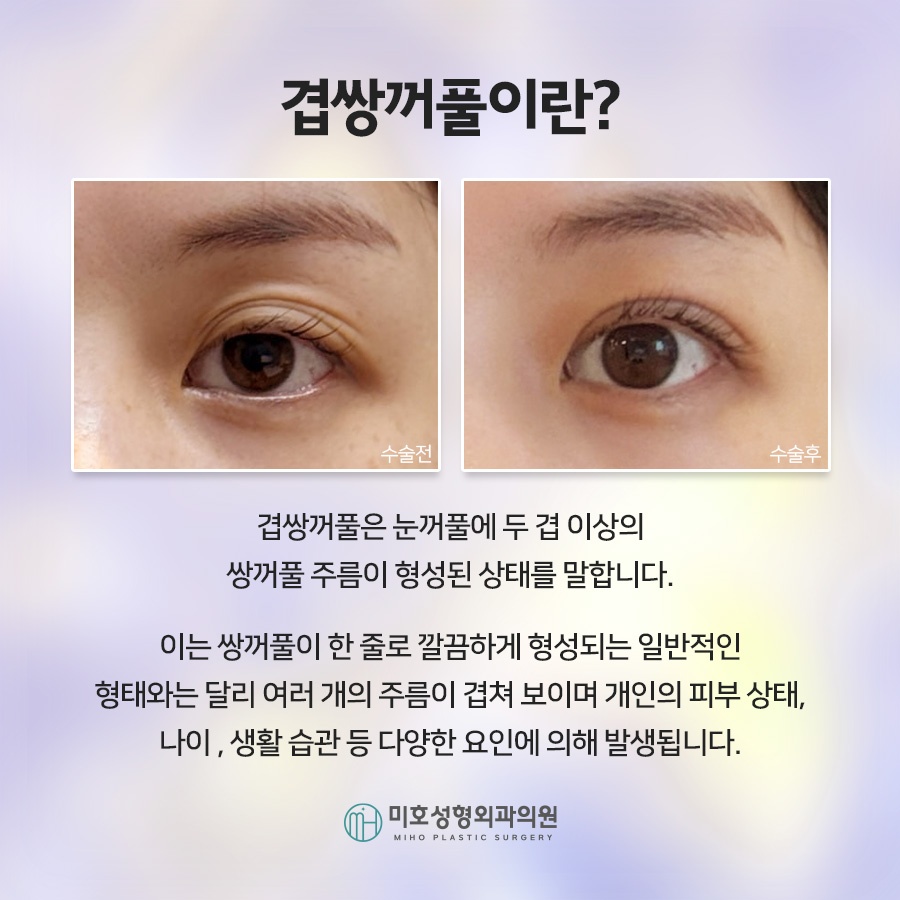 겹쌍꺼풀 깔끔하게 정돈하려면 관련 이미지 2