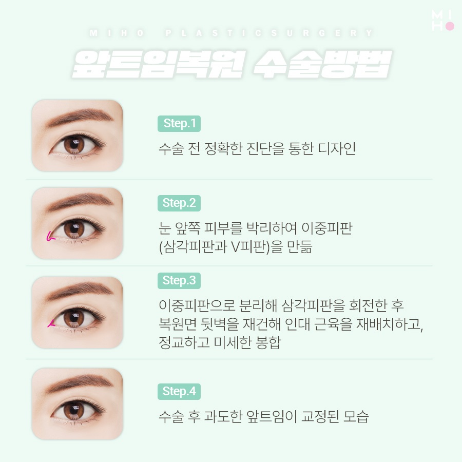 앞트임복원 필요한 상황을 확인하여 관련 이미지 3
