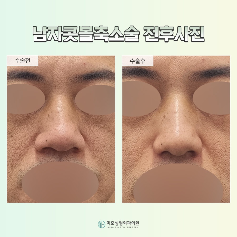 A Successful Guide to Male Alar Reduction for a Refined Appearance image 10