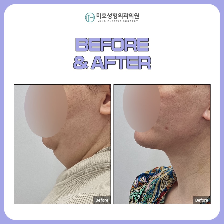 Looking at the Progress of Chin Muscle Ligation for a Double Chin image 9