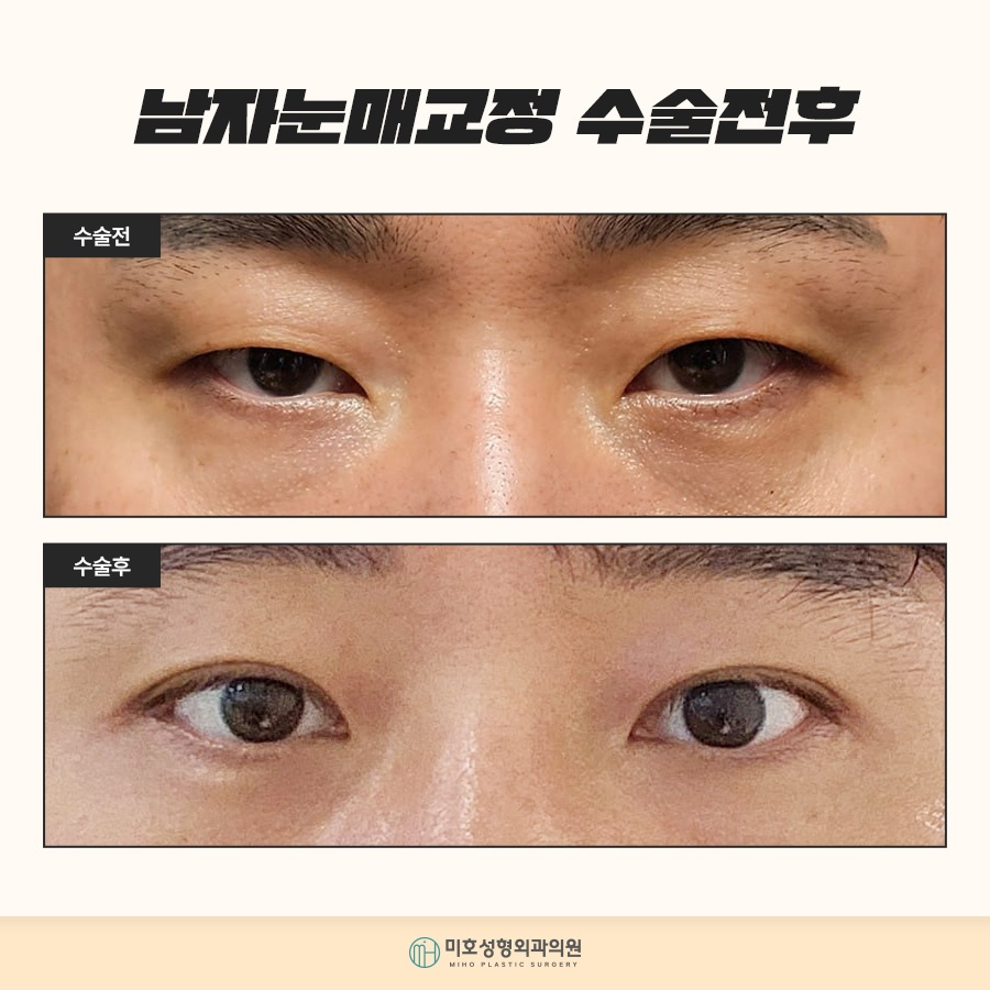 남자눈매교정 자연스러운 이미지로 관련 이미지 7