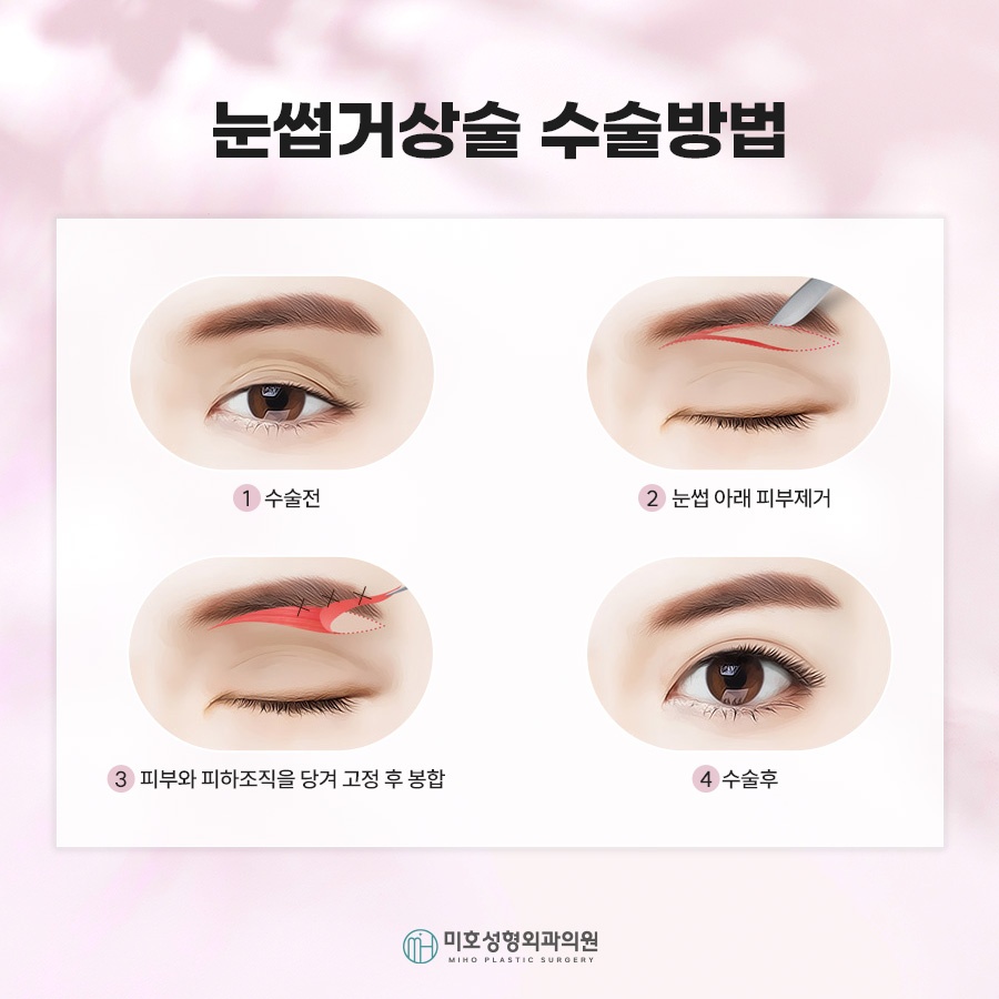 눈썹거상후기 속 주인공이 되는 법 관련 이미지 5
