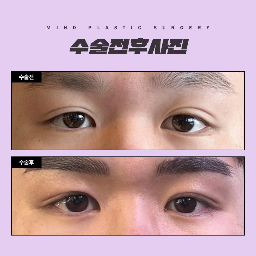 The Key to a Natural Image Transformation with Male Eyelid Surgery image 8