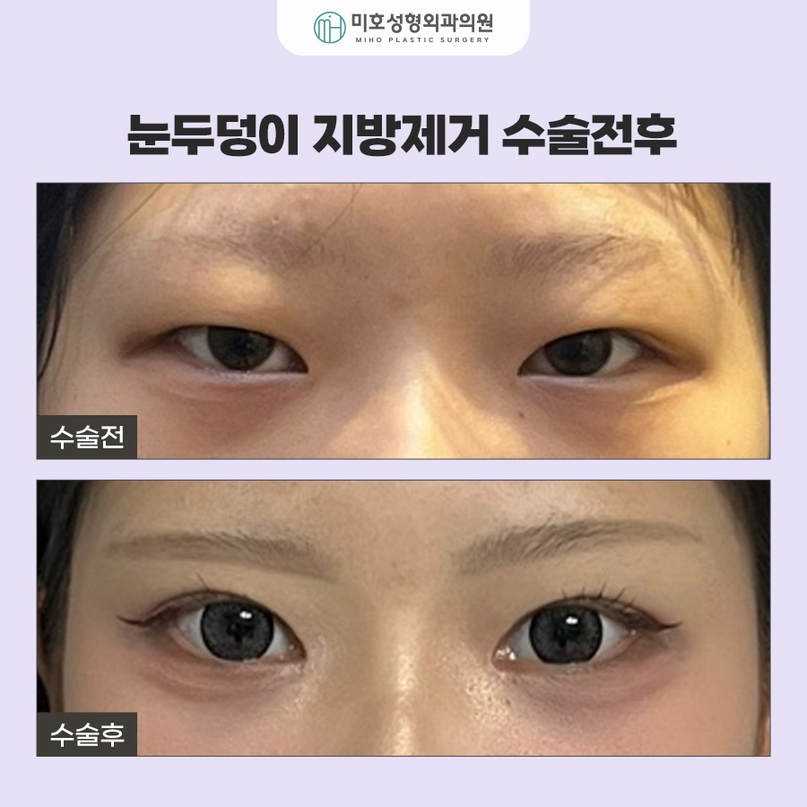 눈두덩이지방제거 눈매 개선 가이드 관련 이미지 7