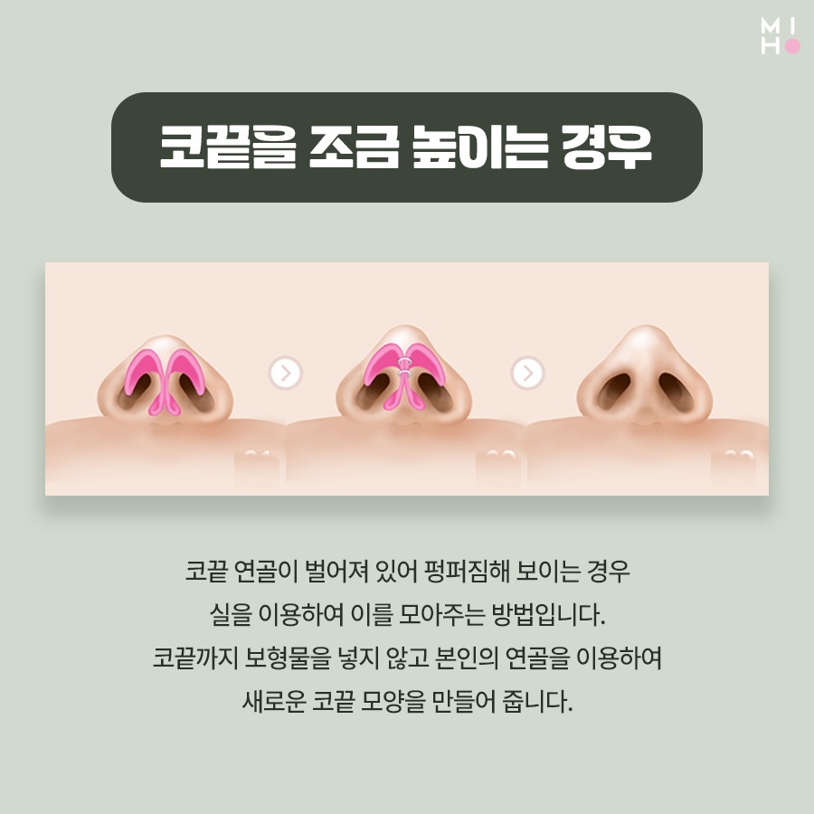 코끝연골묶기 복코 교정을 위한 과정 관련 이미지 5