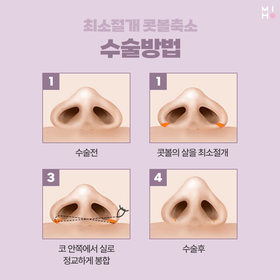 최소절개콧볼축소 부담을 줄이며 세련되게 관련 이미지 3