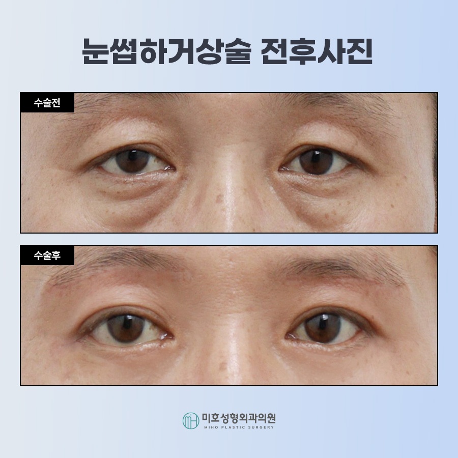 눈썹하거상술 처진 눈 개선 관련 이미지 7