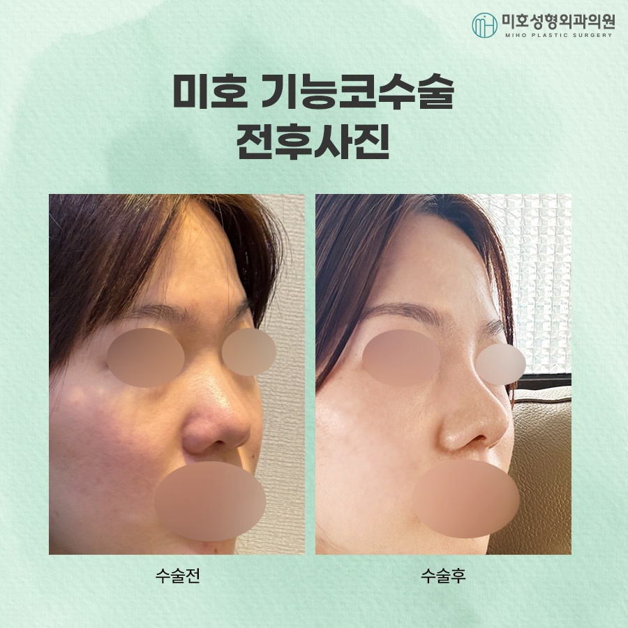 The Progression of a Deviated Nasal Septum and Precautions image 10