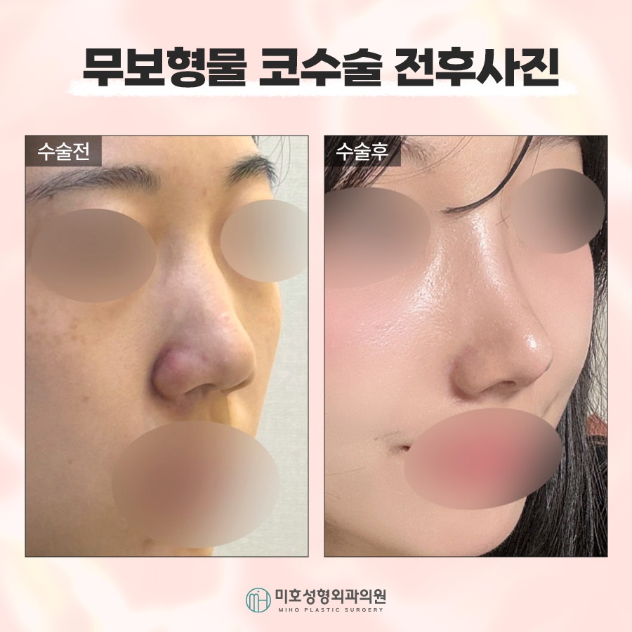 If You Want Harmonious Lines with Nose Surgery Without Implants image 9