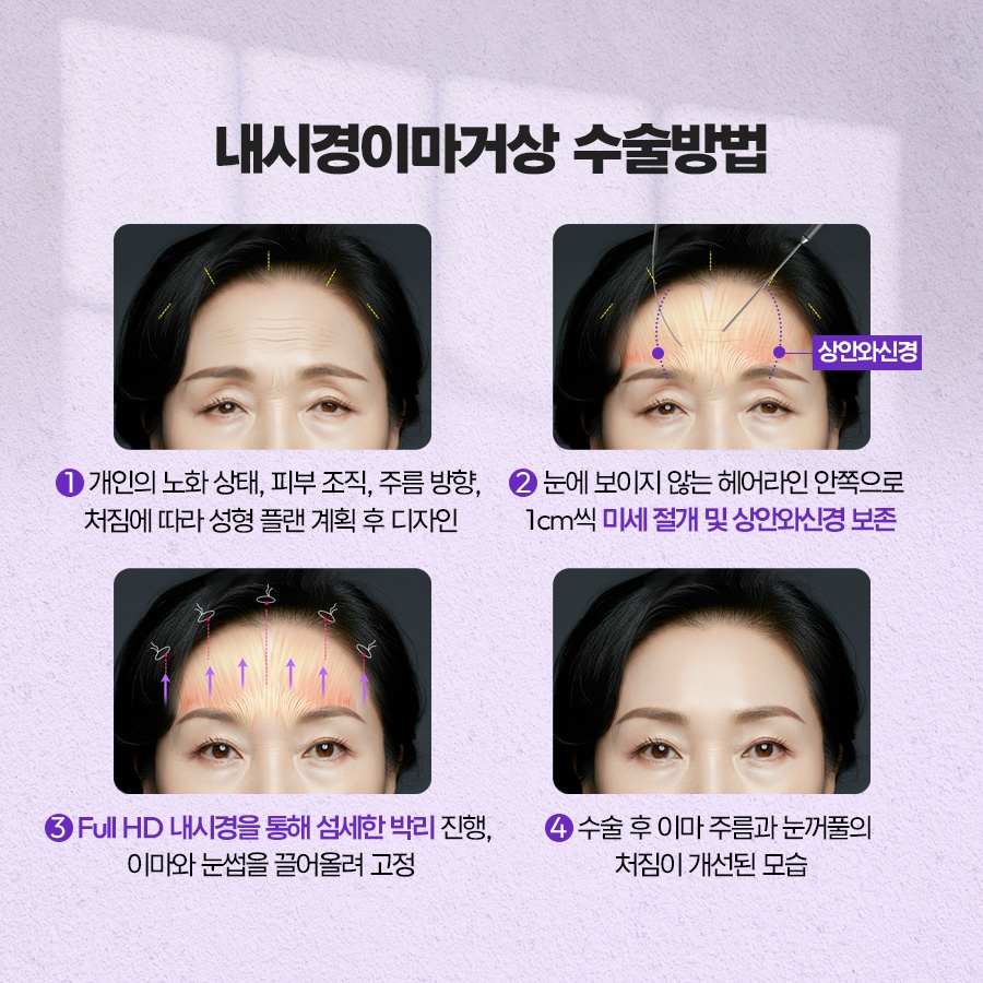 내시경이마거상 처짐 개선 원리 관련 이미지 3