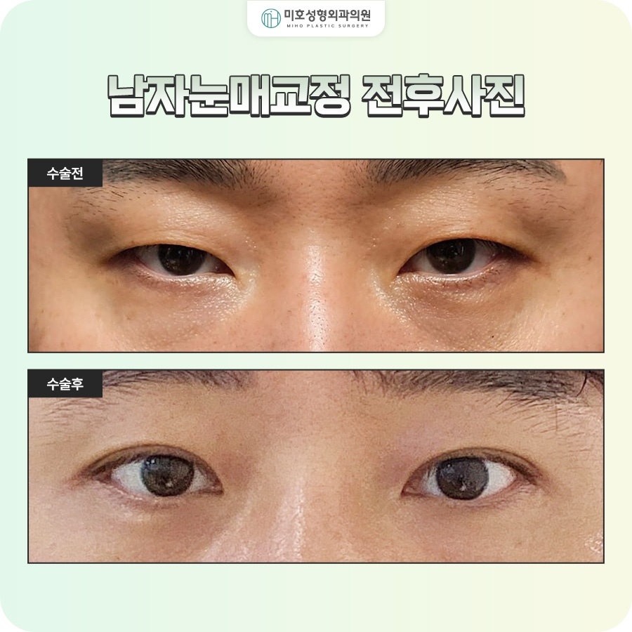 남자눈매교정 졸려 보이는 인상이 고민이라면 관련 이미지 9