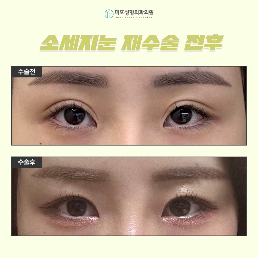 소세지눈재수술 고민된다면 관련 이미지 7