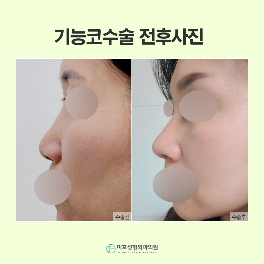 비밸브재건술 기능을 회복시키며 관련 이미지 10