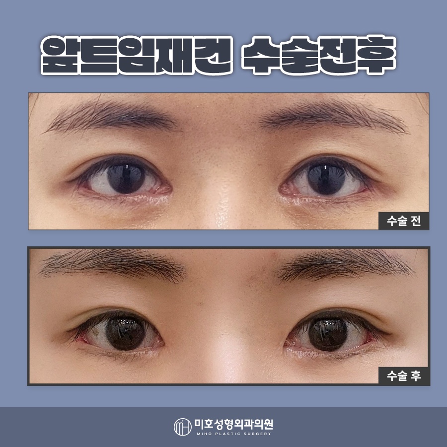 앞트임재건 미세함의 차이로 관련 이미지 8