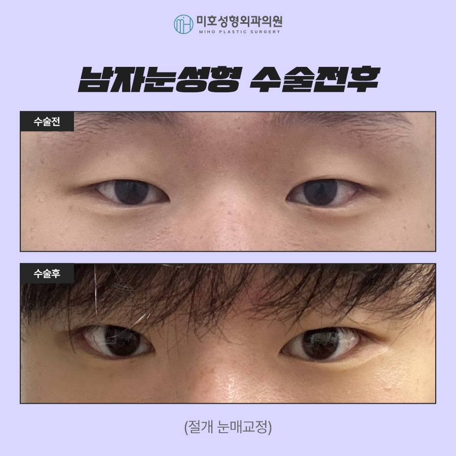남자눈성형 무쌍눈매교정 특징 알아보기 관련 이미지 8