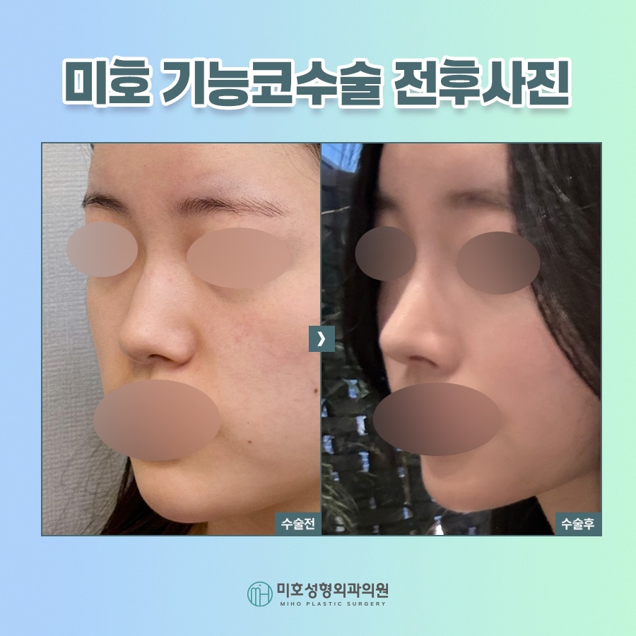 비밸브재건술 진행시 고려할 부분 관련 이미지 9