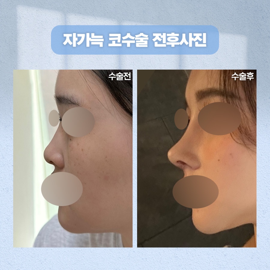 자가늑코수술 재료 특성과 회복 과정 관련 이미지 8