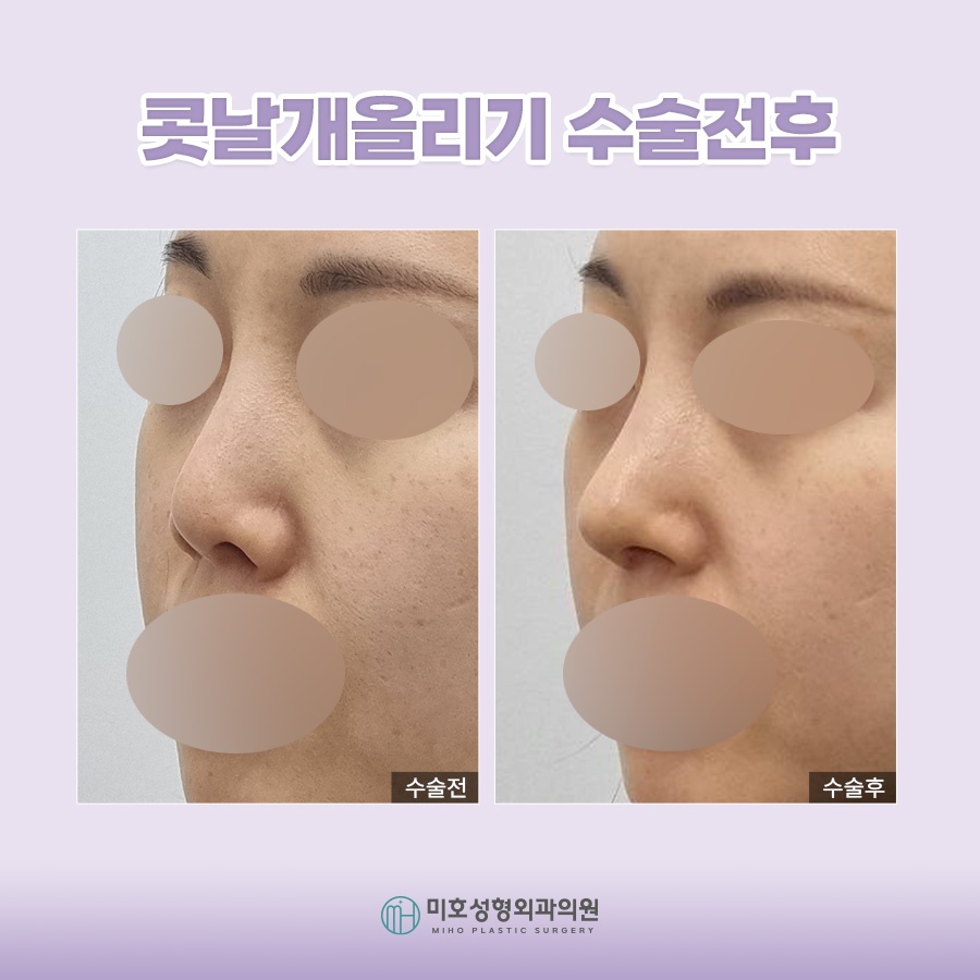 콧날개올리기 개개인에게 맞는 방식으로 관련 이미지 9