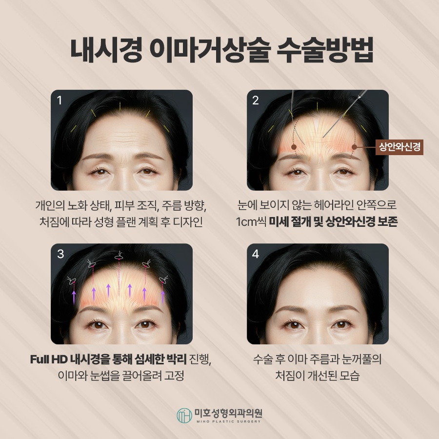 이마거상후기 진행과정 및 체크할 점 관련 이미지 6