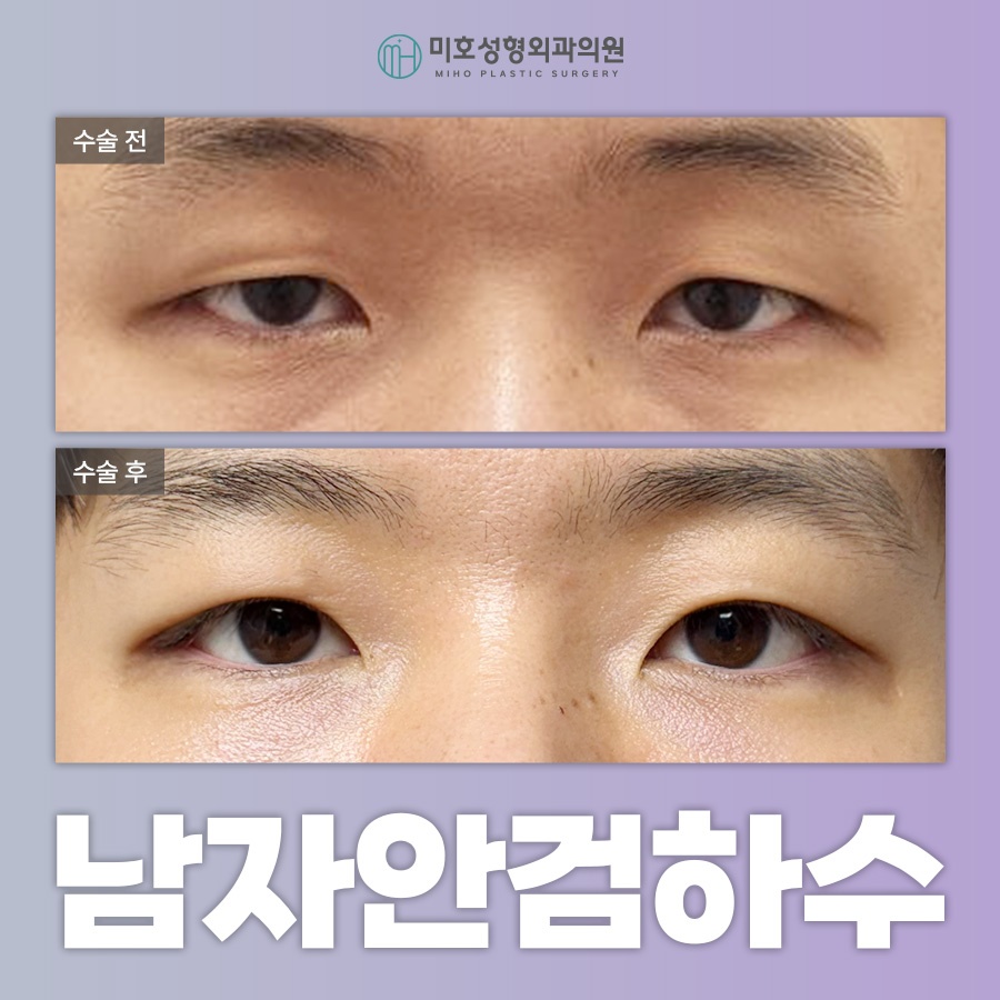 남자안검하수 자연스러움을 바탕으로 관련 이미지 1