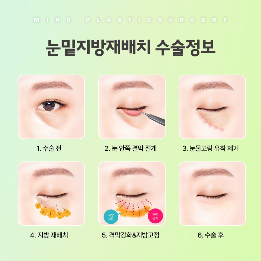 눈밑지방재배치 고민에 맞게 개선하며 관련 이미지 5