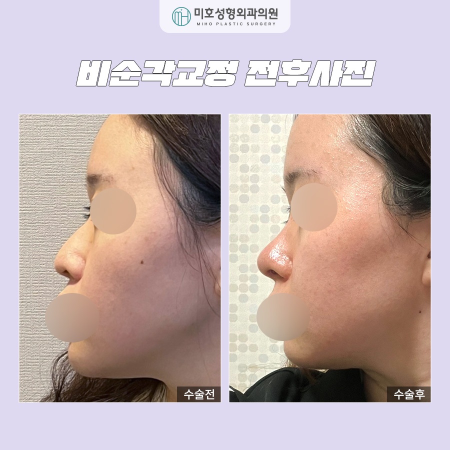 Nasolabial Angle Correction: Who Needs It and How Should It Be Done? image 7