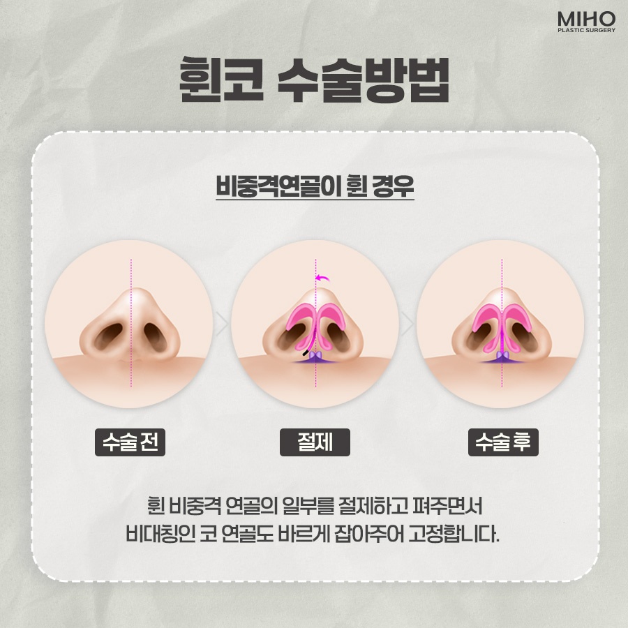 Experiencing the Difference in Crooked Nose Surgery image 6
