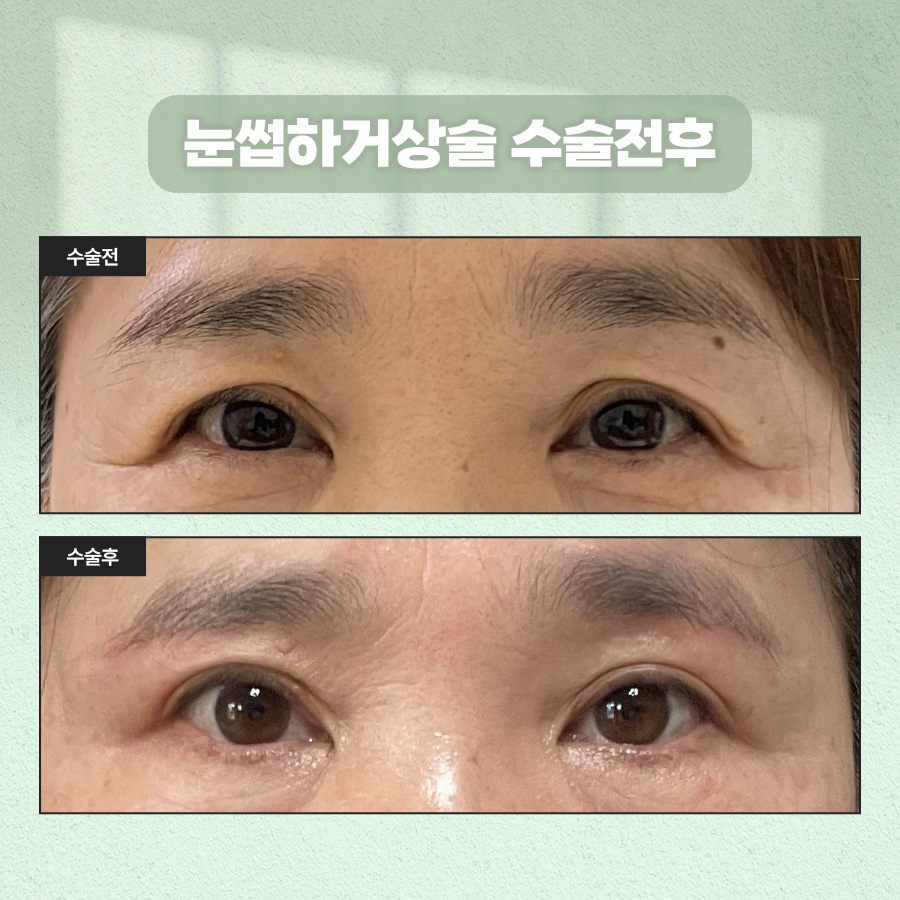 How to Tidy Up Drooping Eyes with Sub-Brow Lift Surgery image 6