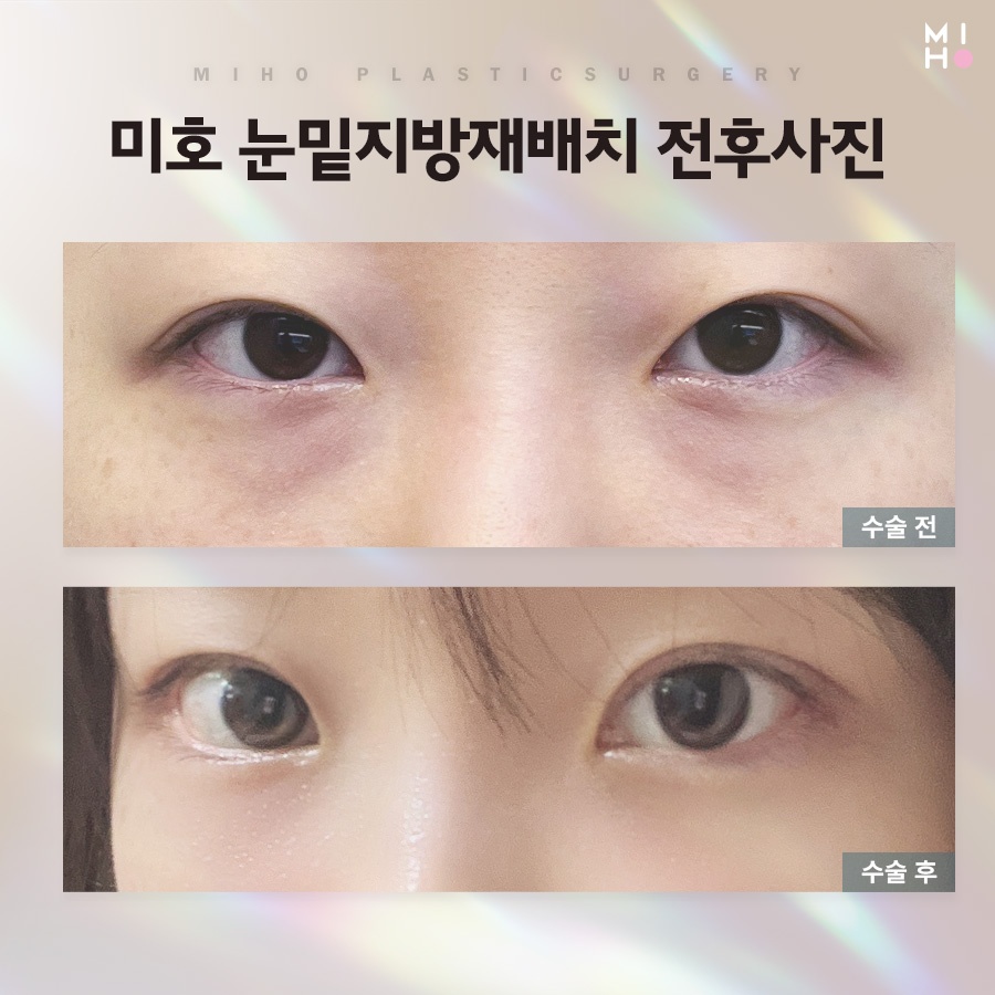 눈밑꺼짐 원인에 맞게 관련 이미지 8