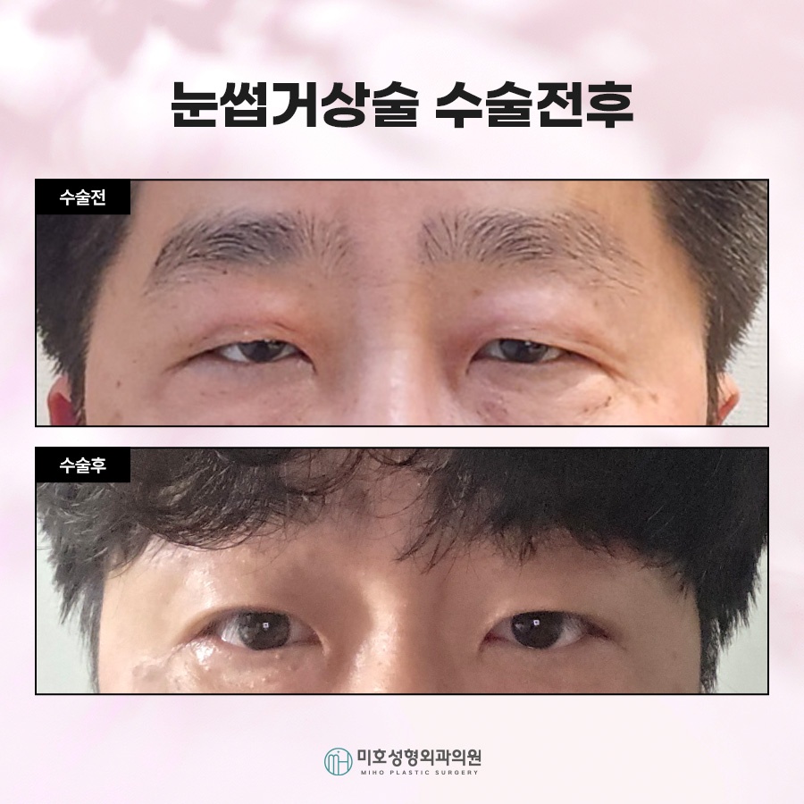 눈썹거상후기 속 주인공이 되는 법 관련 이미지 9